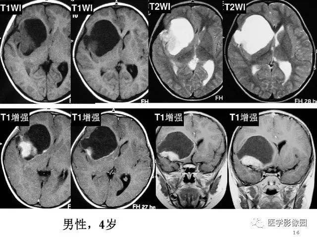 【PPT】颅内少见囊性肿瘤性病变影像诊断