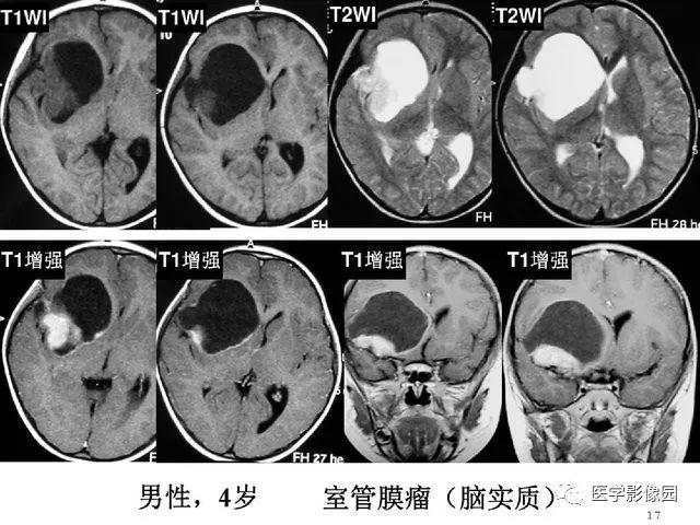 【PPT】颅内少见囊性肿瘤性病变影像诊断
