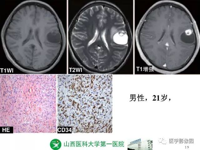 【PPT】颅内少见囊性肿瘤性病变影像诊断