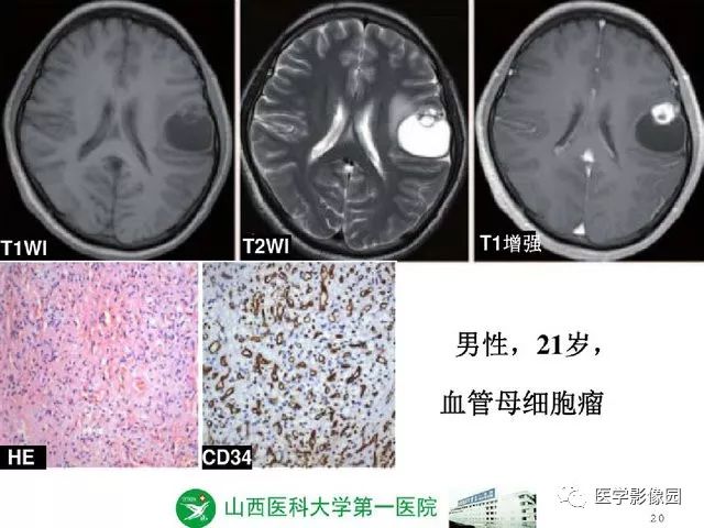 【PPT】颅内少见囊性肿瘤性病变影像诊断