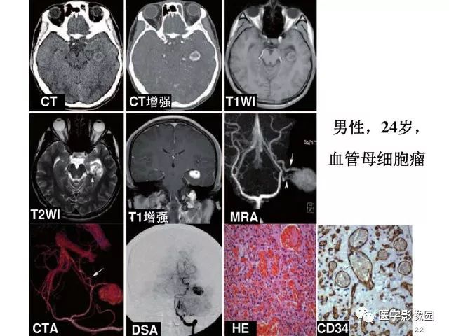 【PPT】颅内少见囊性肿瘤性病变影像诊断