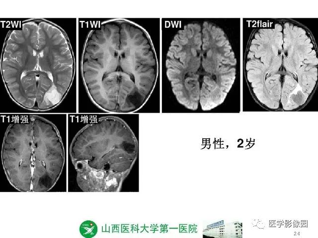 【PPT】颅内少见囊性肿瘤性病变影像诊断