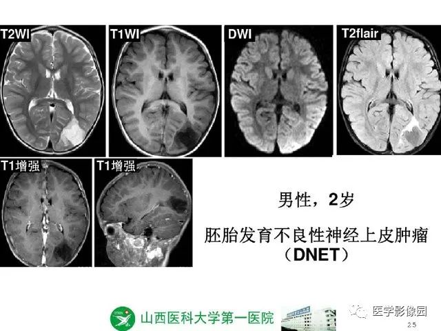 【PPT】颅内少见囊性肿瘤性病变影像诊断