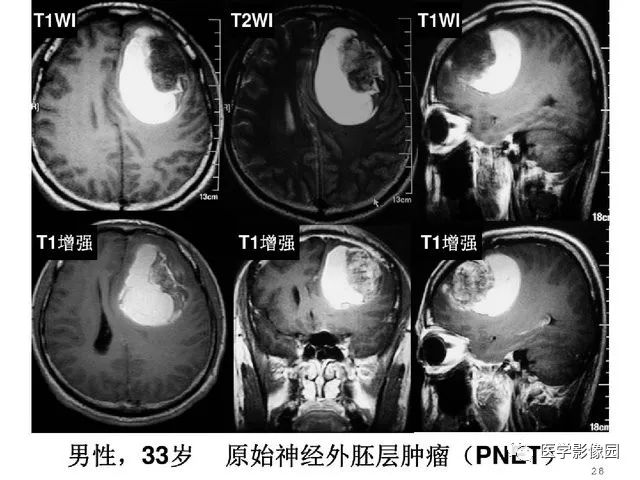 【PPT】颅内少见囊性肿瘤性病变影像诊断