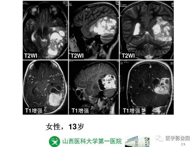 【PPT】颅内少见囊性肿瘤性病变影像诊断