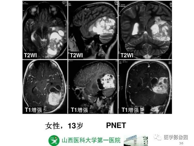 【PPT】颅内少见囊性肿瘤性病变影像诊断