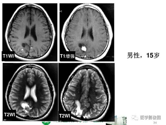 【PPT】颅内少见囊性肿瘤性病变影像诊断