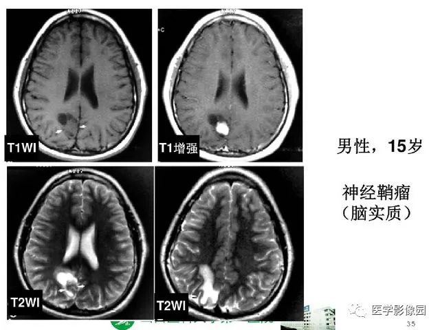【PPT】颅内少见囊性肿瘤性病变影像诊断