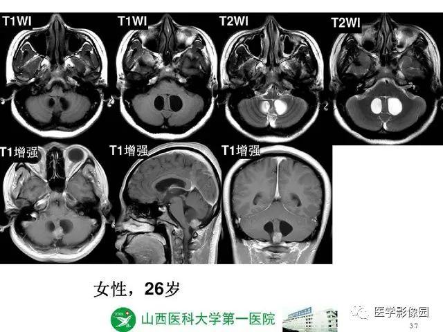 【PPT】颅内少见囊性肿瘤性病变影像诊断