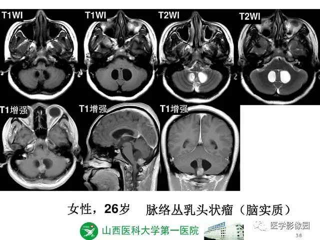【PPT】颅内少见囊性肿瘤性病变影像诊断