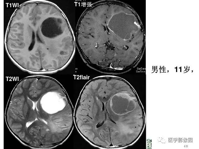 【PPT】颅内少见囊性肿瘤性病变影像诊断