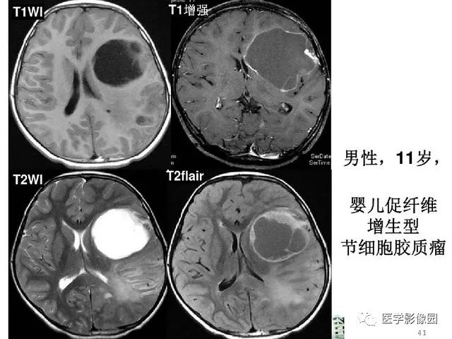 【PPT】颅内少见囊性肿瘤性病变影像诊断