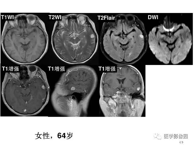 【PPT】颅内少见囊性肿瘤性病变影像诊断
