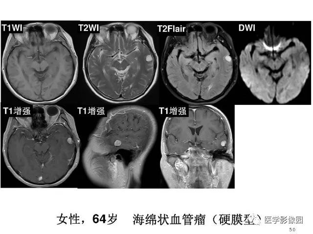 【PPT】颅内少见囊性肿瘤性病变影像诊断