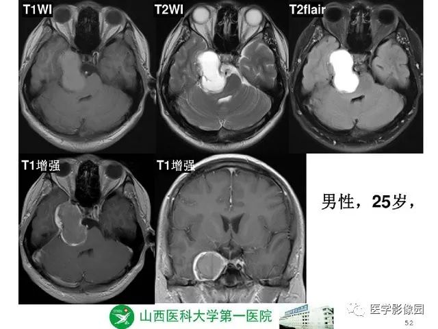 【PPT】颅内少见囊性肿瘤性病变影像诊断