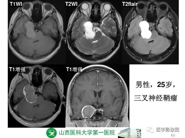 【PPT】颅内少见囊性肿瘤性病变影像诊断