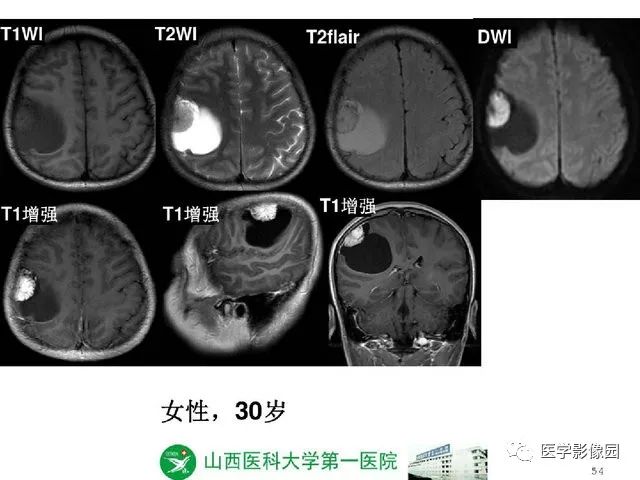 【PPT】颅内少见囊性肿瘤性病变影像诊断