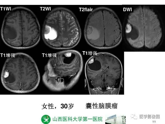 【PPT】颅内少见囊性肿瘤性病变影像诊断