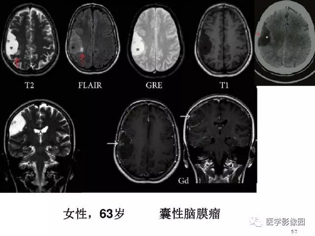 【PPT】颅内少见囊性肿瘤性病变影像诊断