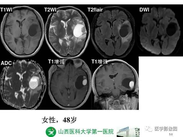 【PPT】颅内少见囊性肿瘤性病变影像诊断