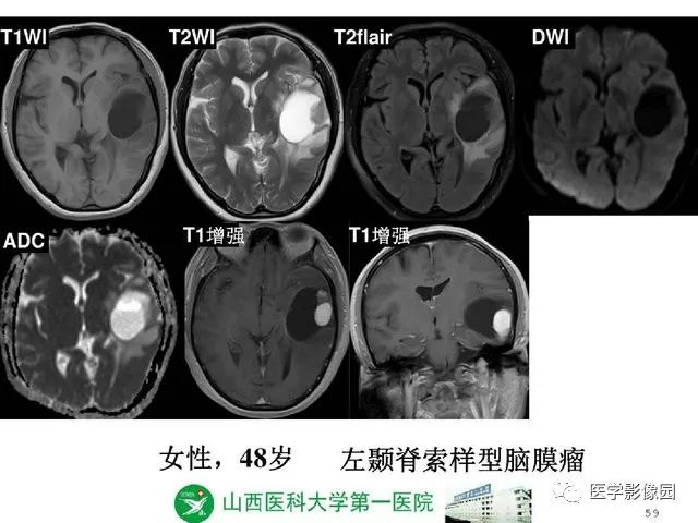【PPT】颅内少见囊性肿瘤性病变影像诊断