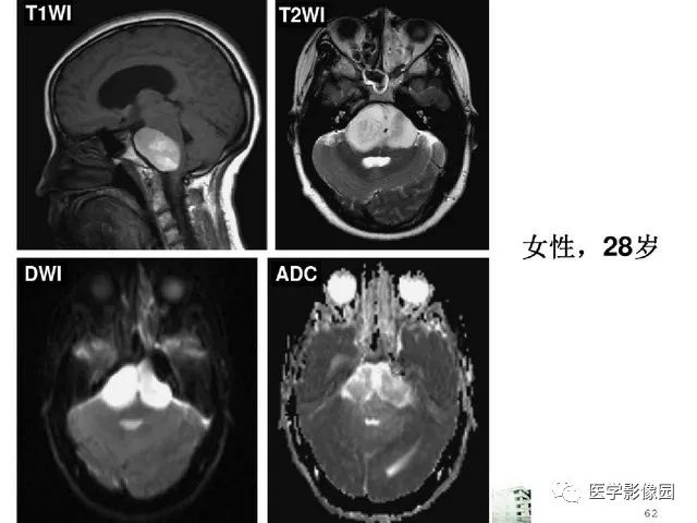 【PPT】颅内少见囊性肿瘤性病变影像诊断