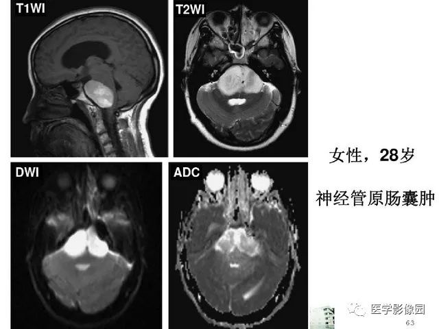 【PPT】颅内少见囊性肿瘤性病变影像诊断