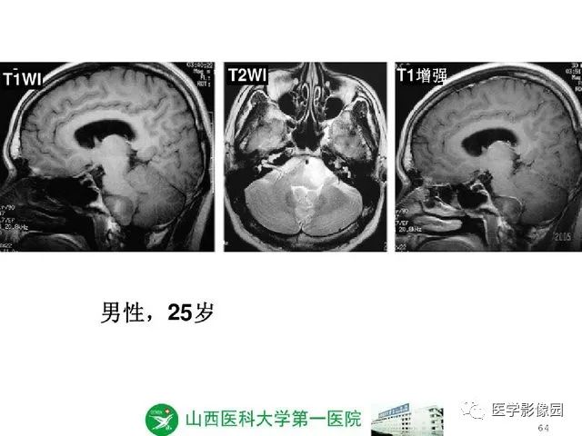 【PPT】颅内少见囊性肿瘤性病变影像诊断