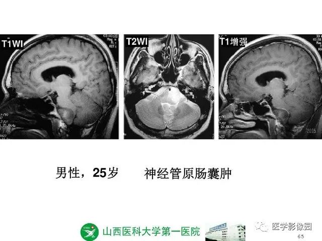 【PPT】颅内少见囊性肿瘤性病变影像诊断