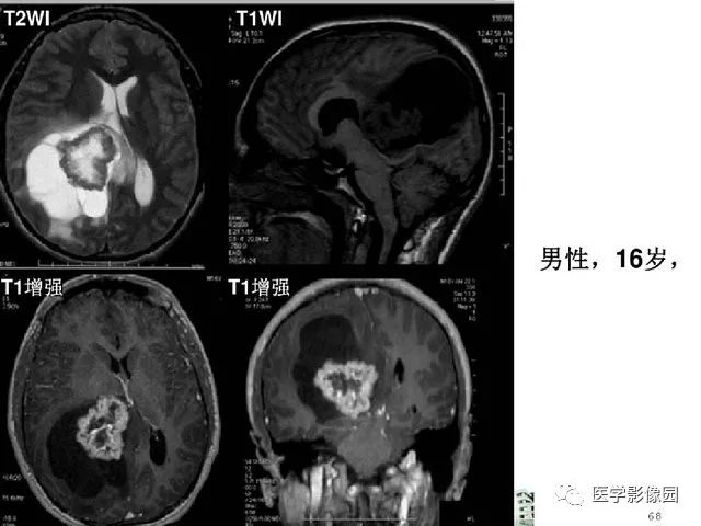 【PPT】颅内少见囊性肿瘤性病变影像诊断