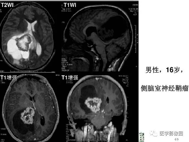 【PPT】颅内少见囊性肿瘤性病变影像诊断