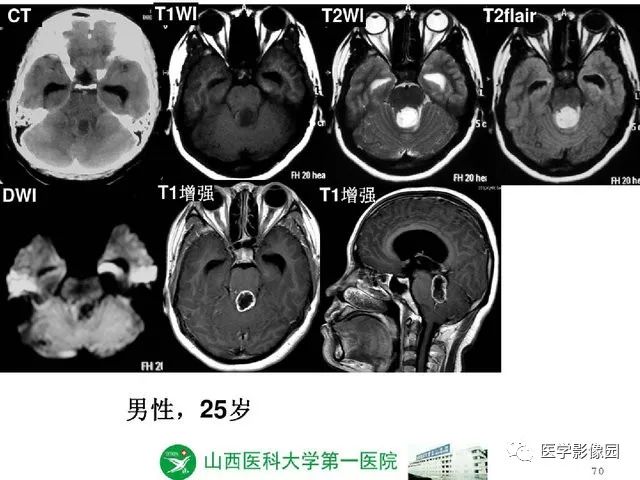 【PPT】颅内少见囊性肿瘤性病变影像诊断