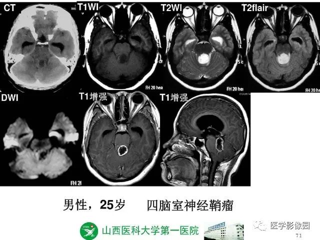 【PPT】颅内少见囊性肿瘤性病变影像诊断