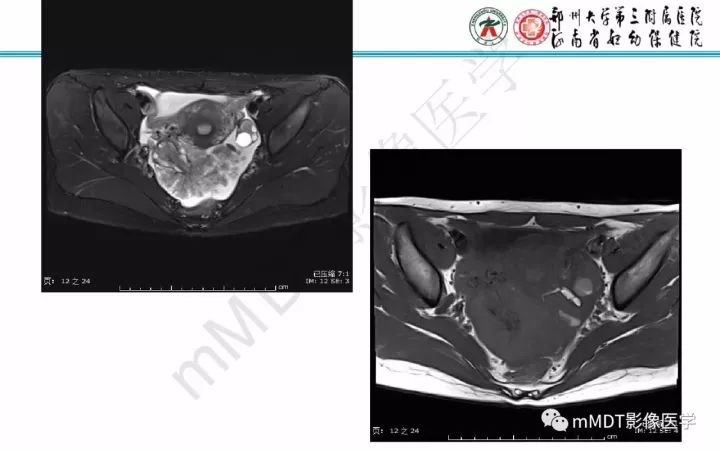 【PPT】卵巢肿瘤的影像诊断思路