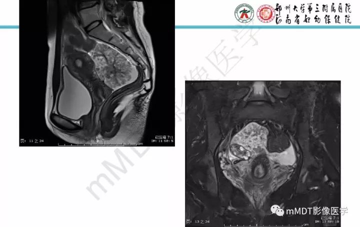 【PPT】卵巢肿瘤的影像诊断思路