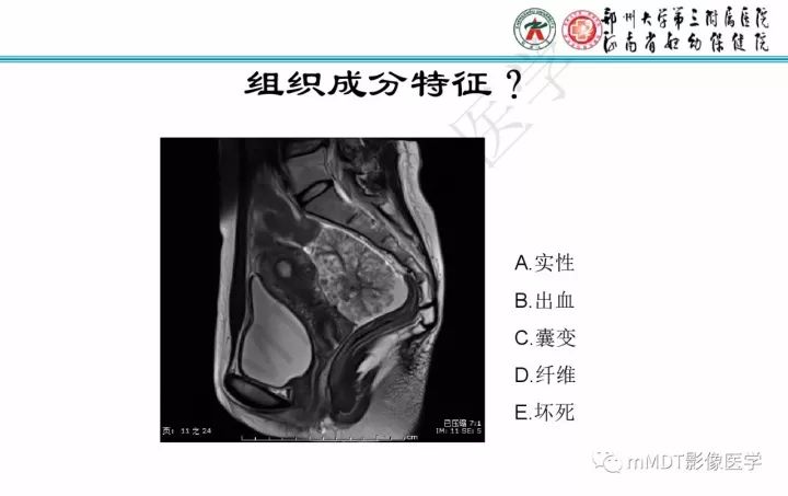 【PPT】卵巢肿瘤的影像诊断思路