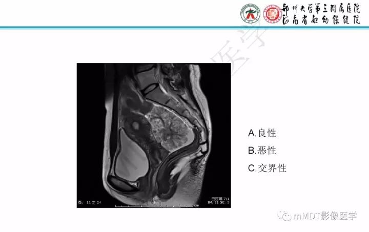 【PPT】卵巢肿瘤的影像诊断思路