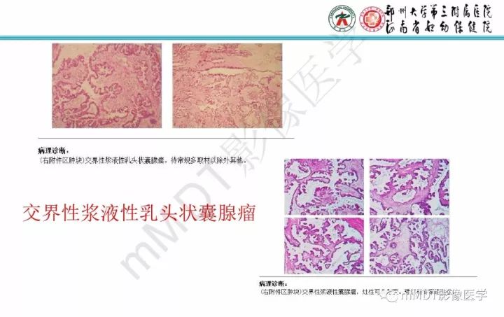 【PPT】卵巢肿瘤的影像诊断思路