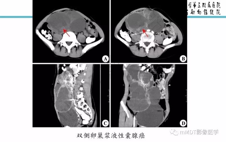 【PPT】卵巢肿瘤的影像诊断思路