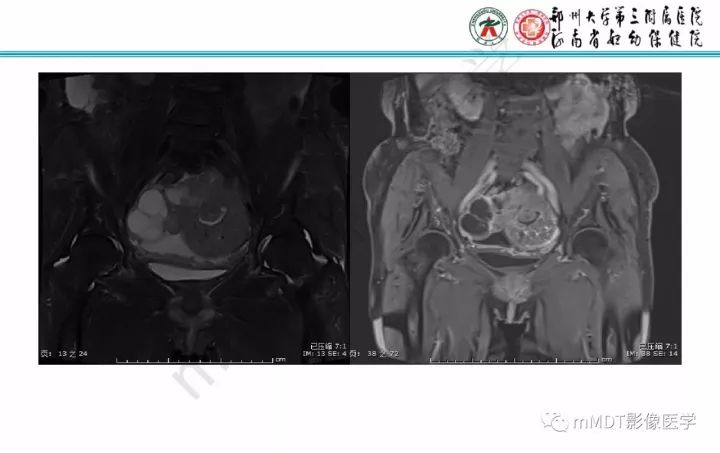 【PPT】卵巢肿瘤的影像诊断思路