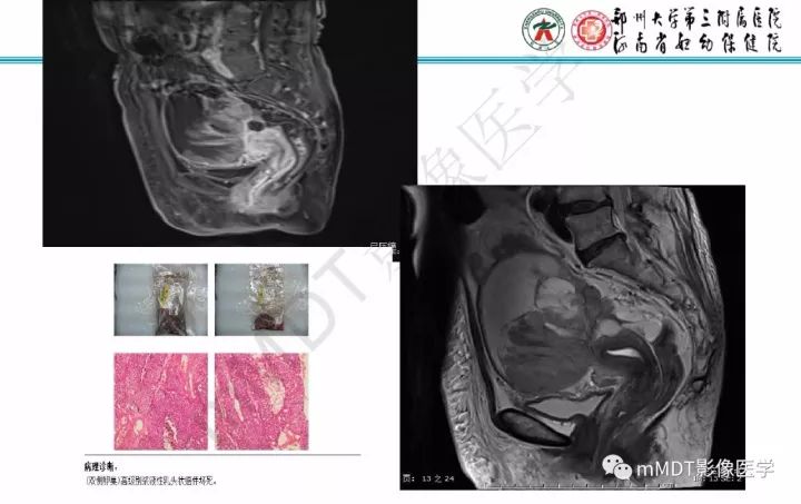 【PPT】卵巢肿瘤的影像诊断思路