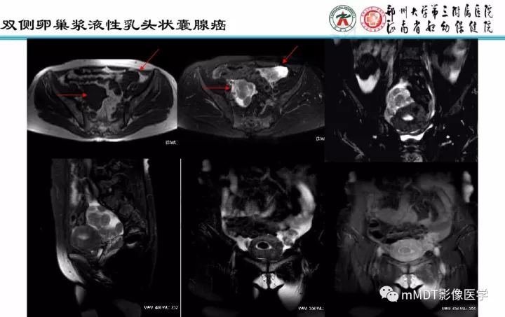 【PPT】卵巢肿瘤的影像诊断思路