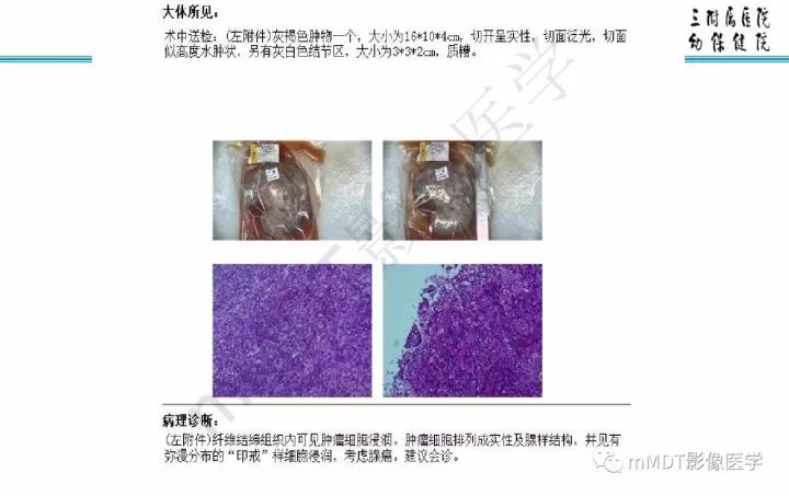 【PPT】卵巢肿瘤的影像诊断思路