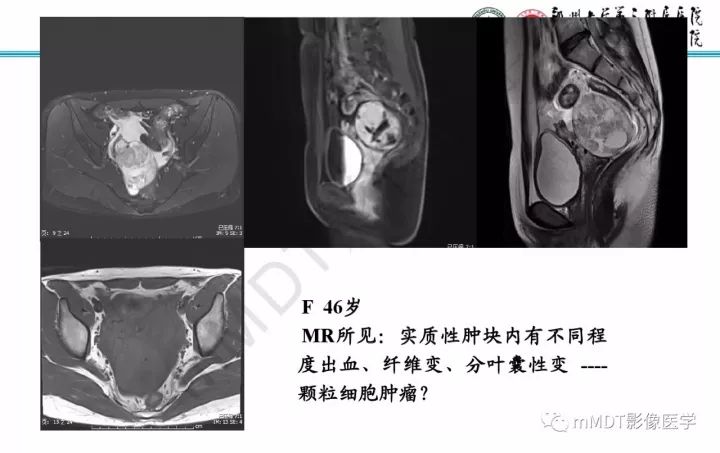 【PPT】卵巢肿瘤的影像诊断思路