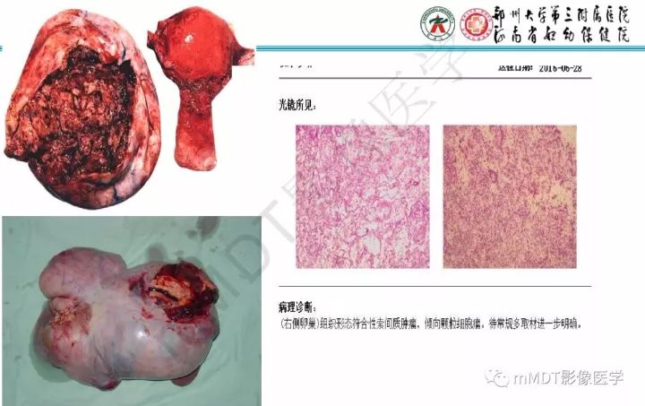 【PPT】卵巢肿瘤的影像诊断思路