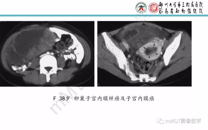 【PPT】卵巢肿瘤的影像诊断思路