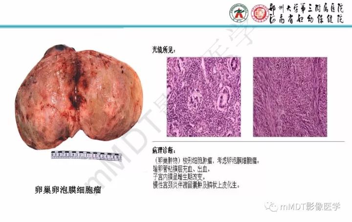 【PPT】卵巢肿瘤的影像诊断思路