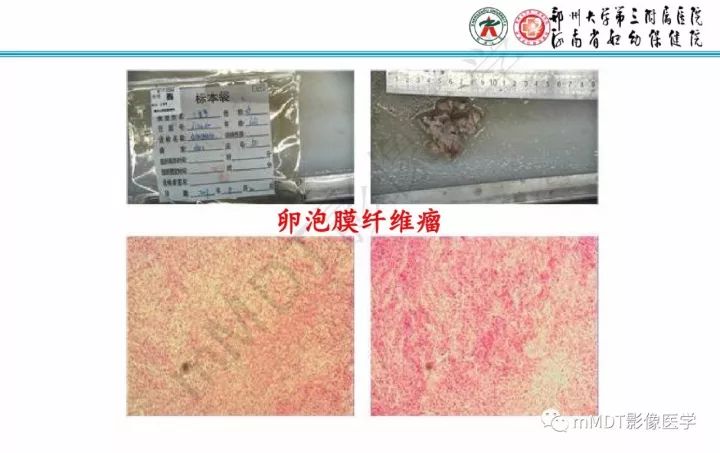 【PPT】卵巢肿瘤的影像诊断思路