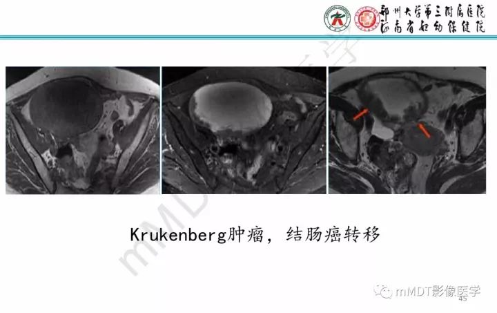 【PPT】卵巢肿瘤的影像诊断思路