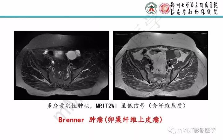 【PPT】卵巢肿瘤的影像诊断思路